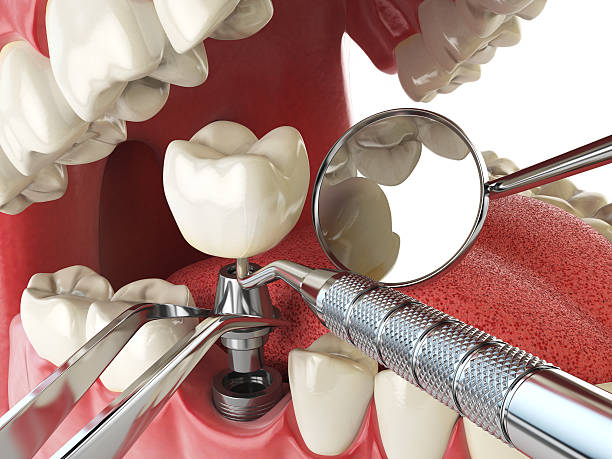 Best Emergency Tooth Extraction in Belleville, KS